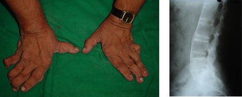 Arthritis 1 Arthritis 1