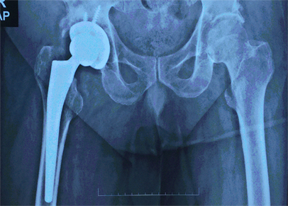 Primary Hip Replacement 1 Primary Hip Replacement 1